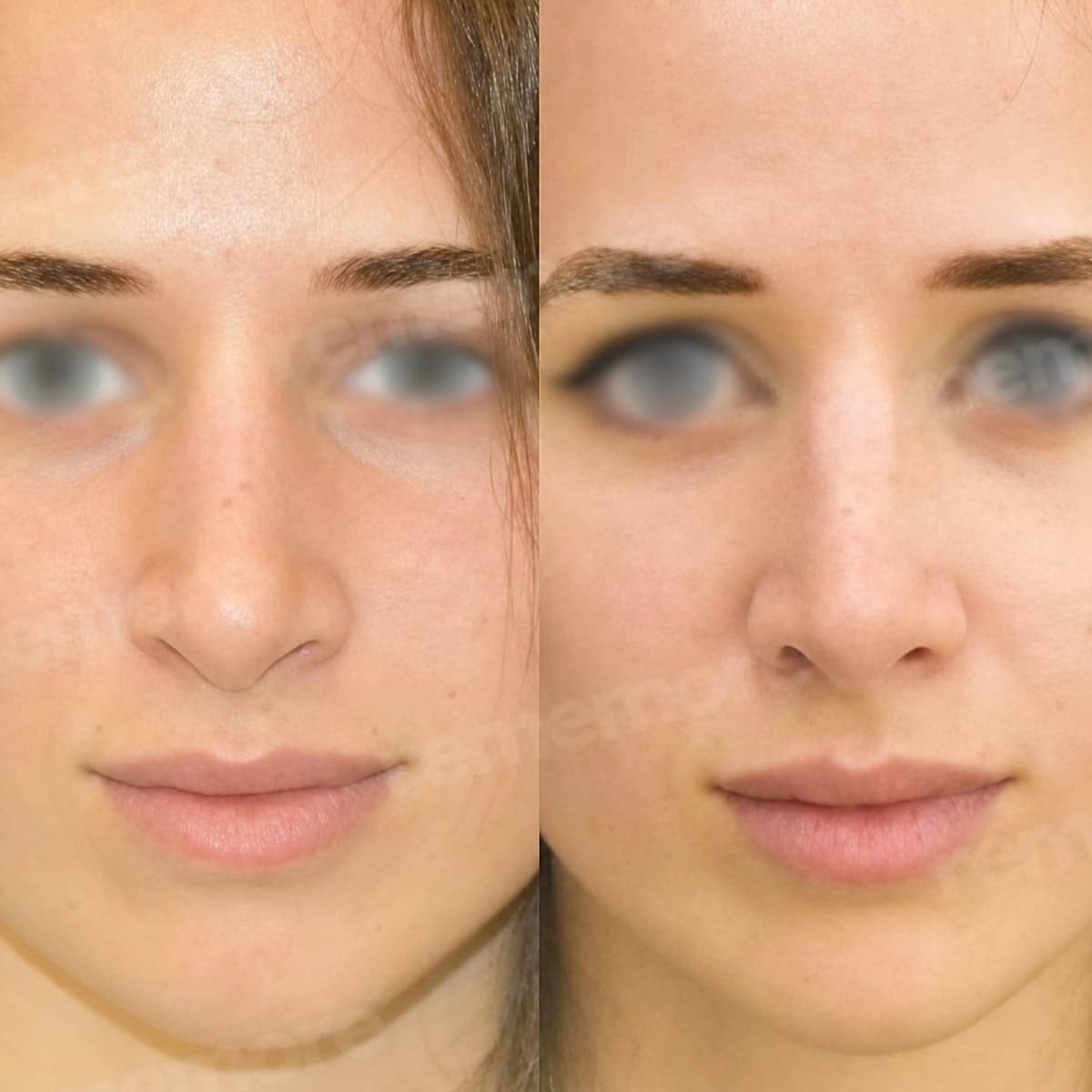 Case 15678 - rhinoplasty