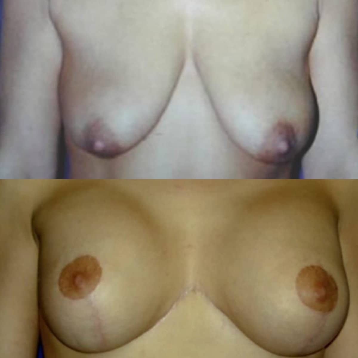Case 15682 - breast implants with lift