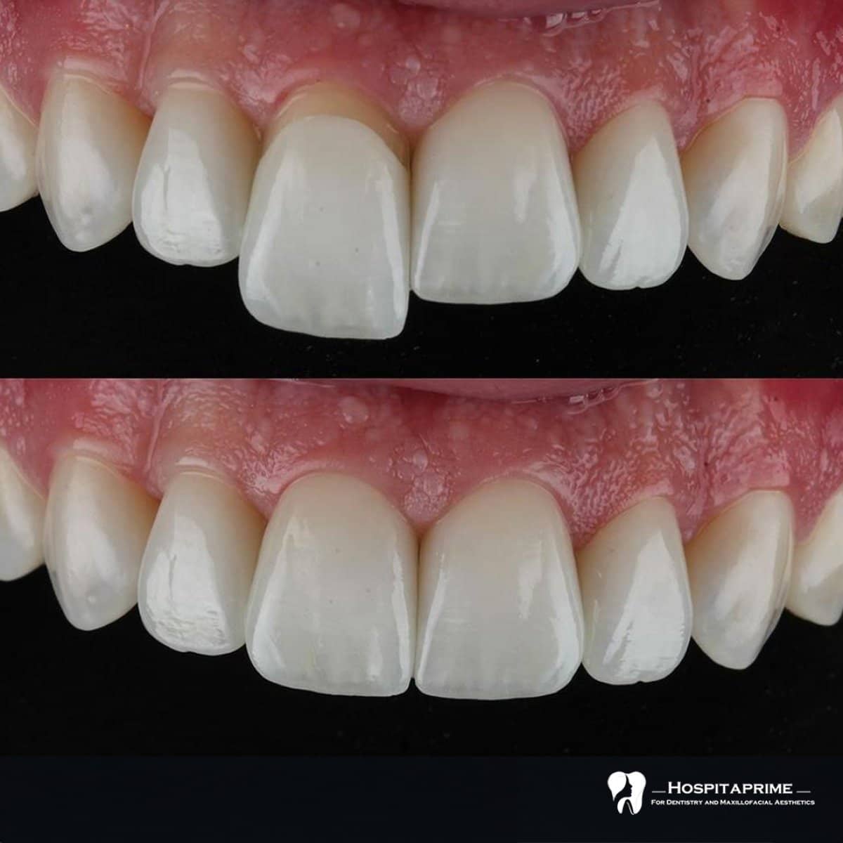 Case 15719 - veneers