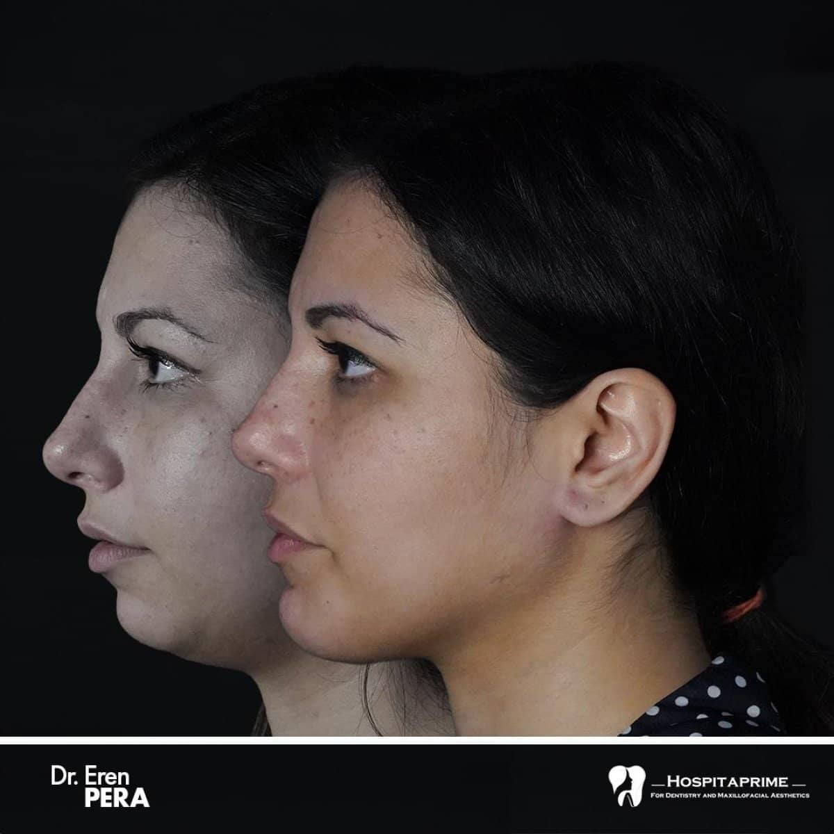 Case 15720 - orthognathic surgery