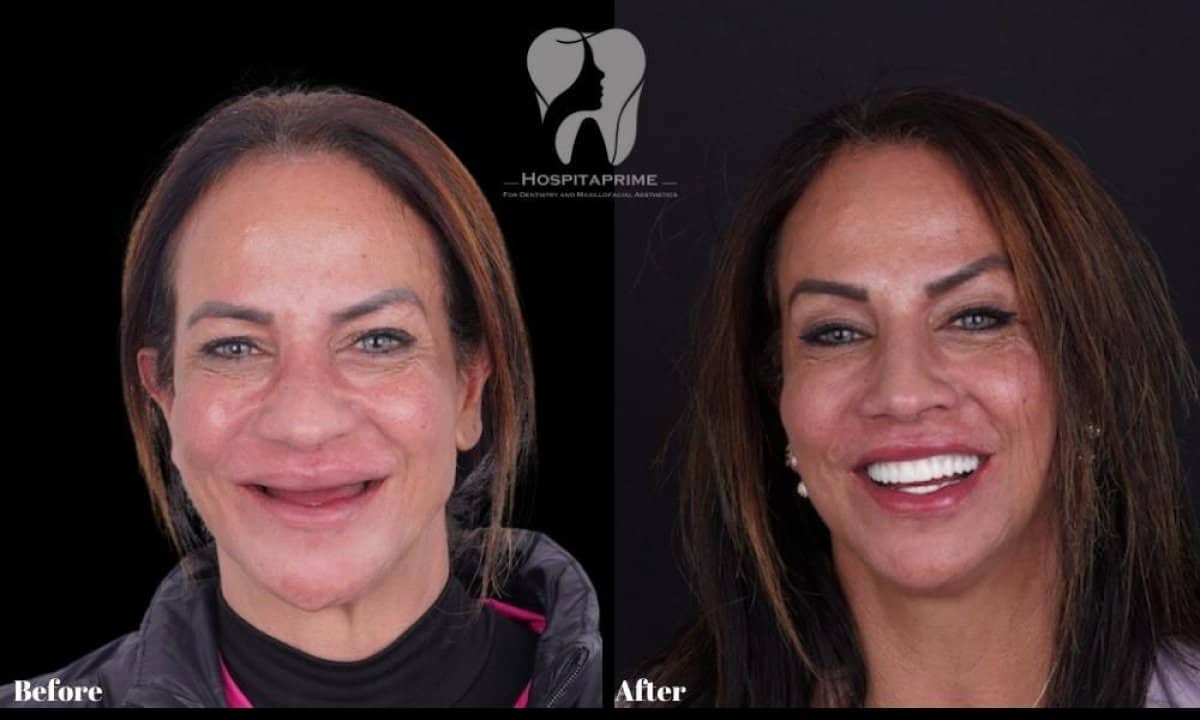Case 15723 - All-on-6 dental implants