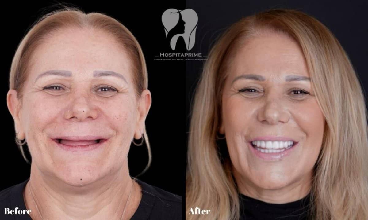 Case 15729 - All-on-6 dental implants