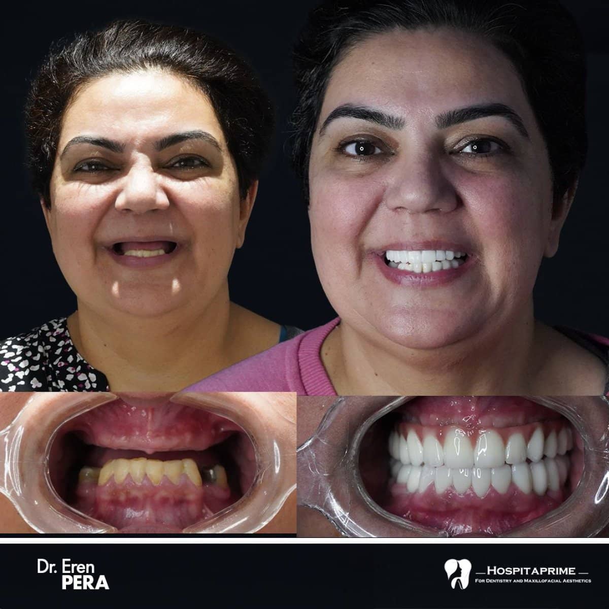 Case 15732 - All-on-6 dental implants