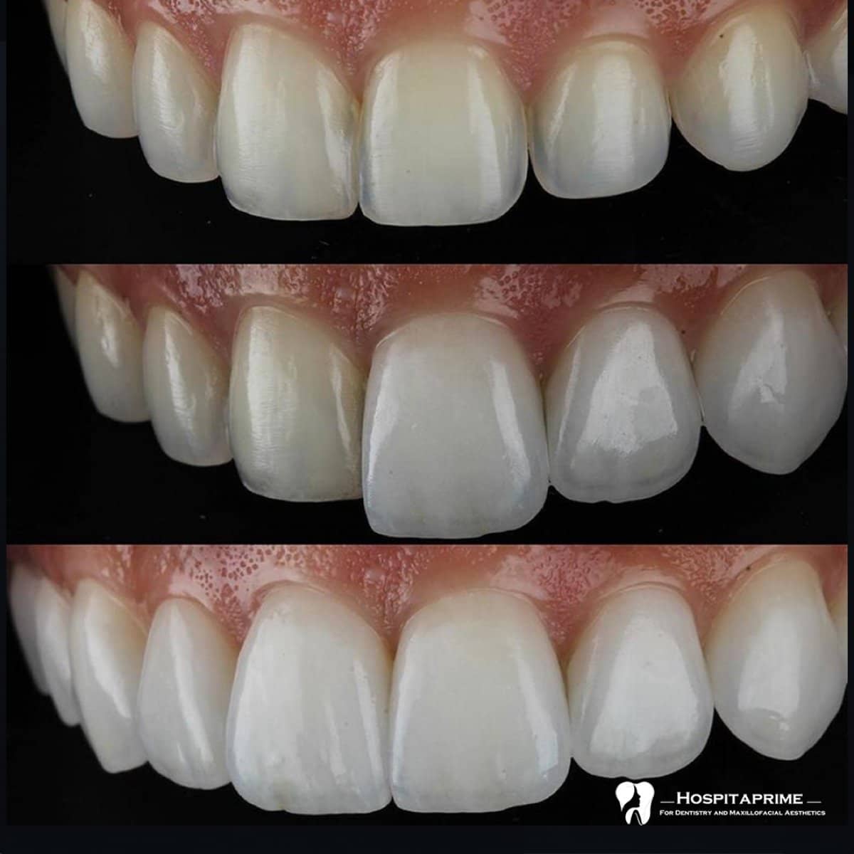 Case 15733 - veneers