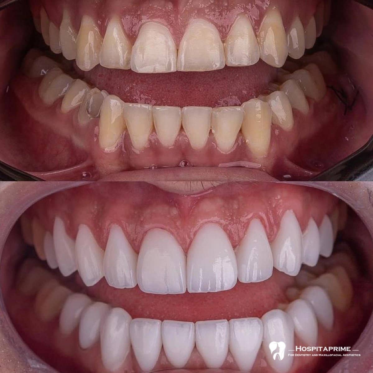 Case 15736 - Lumineer