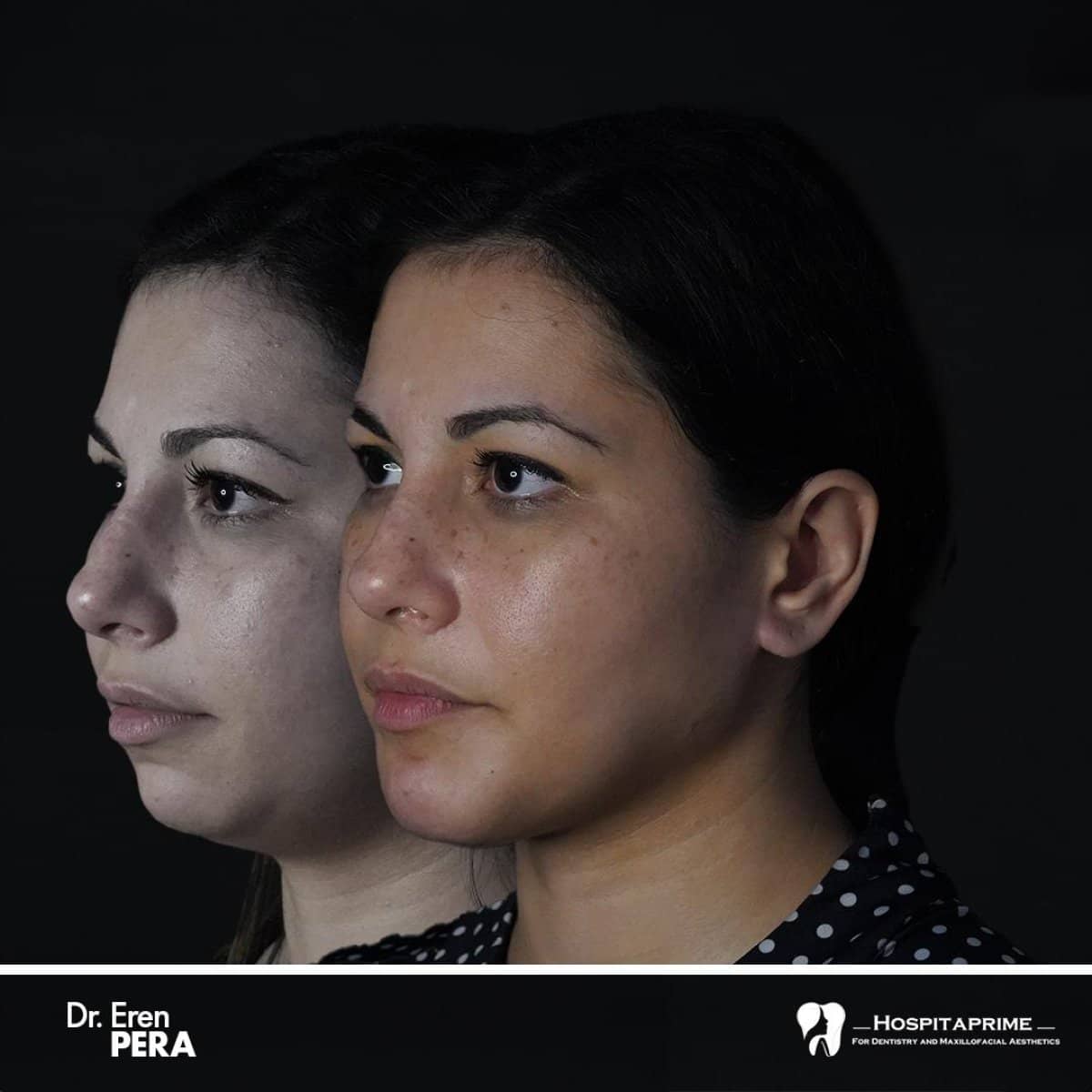 Case 15737 - orthognathic surgery
