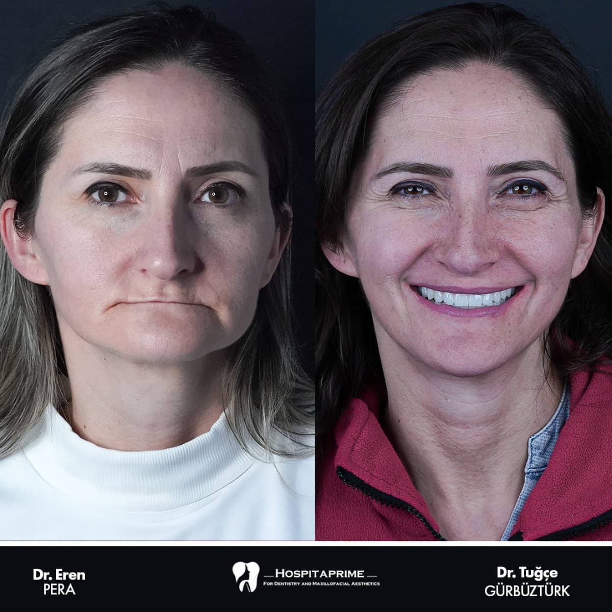 Case 15738 - zygomatic implant