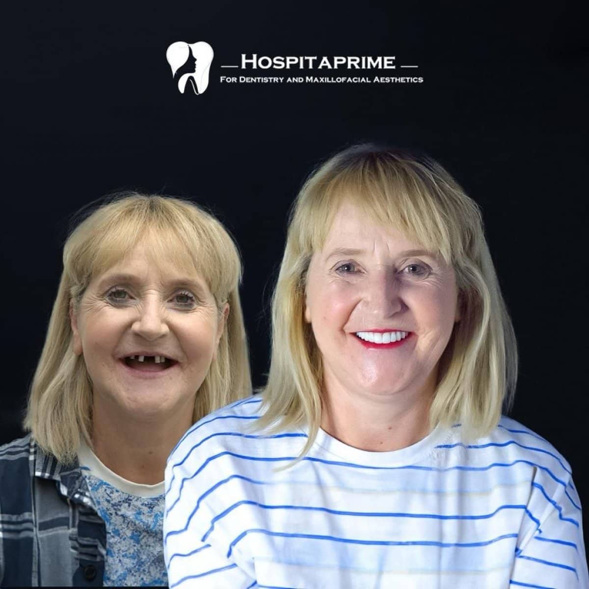 Case 15740 - All-on-4 dental implants