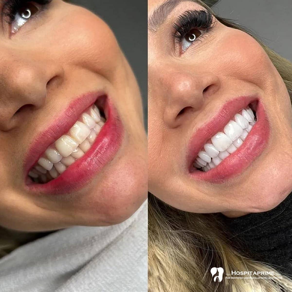 Case 15741 - zirconia veneers