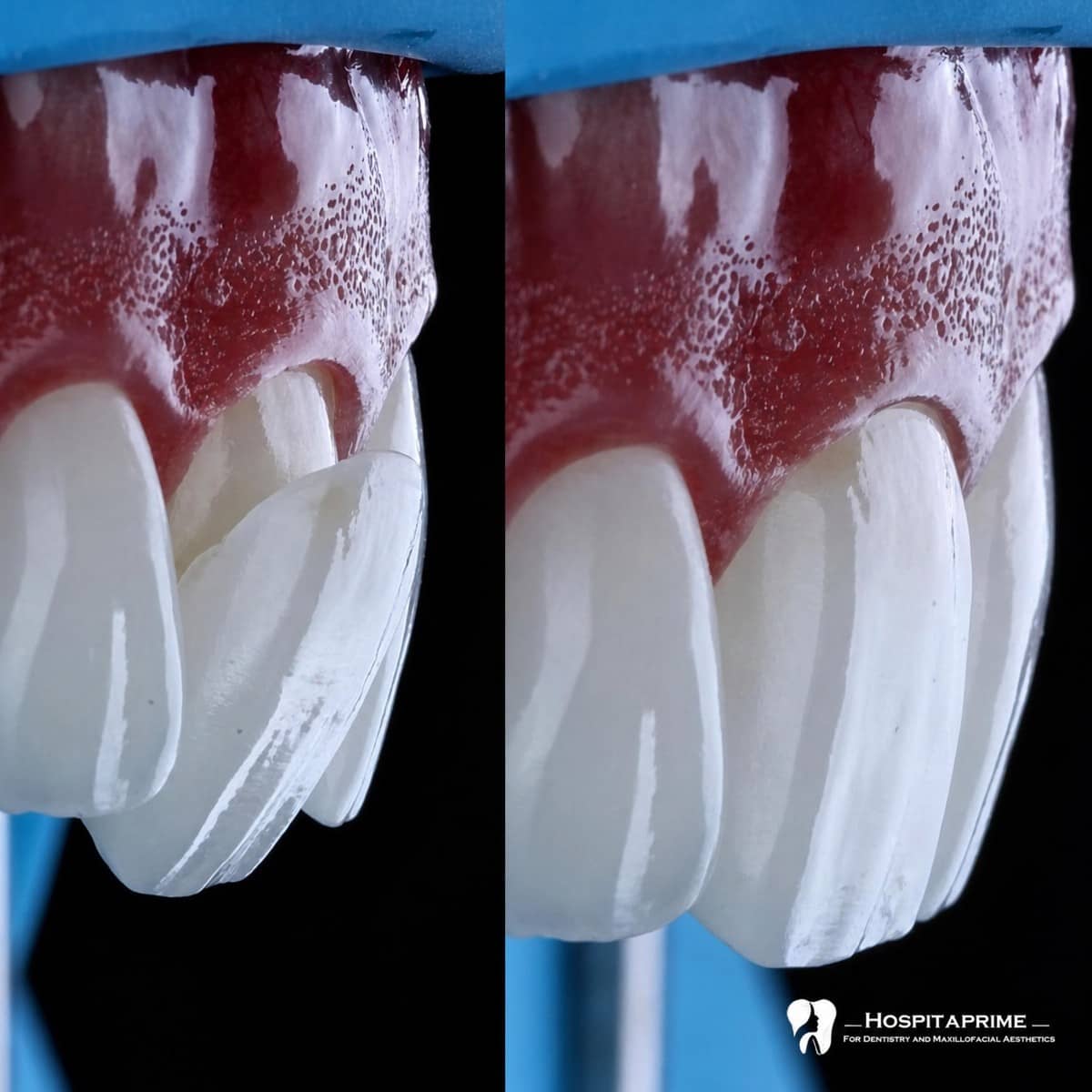 Case 15742 - veneers