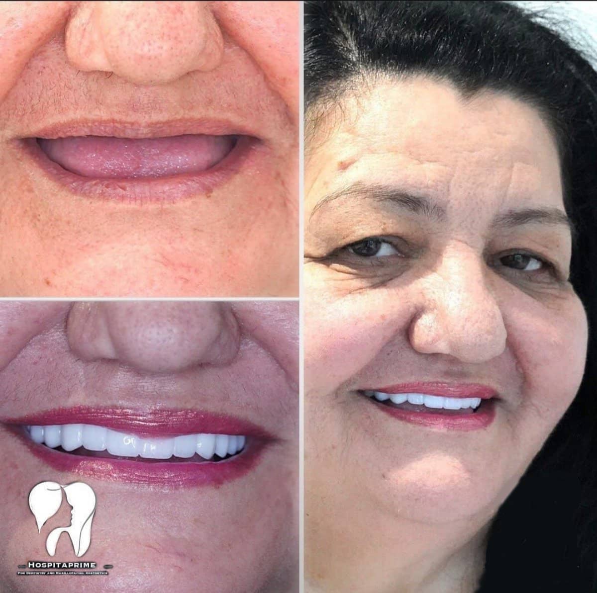 Case 15743 - Zygomatic All-on-4 implants