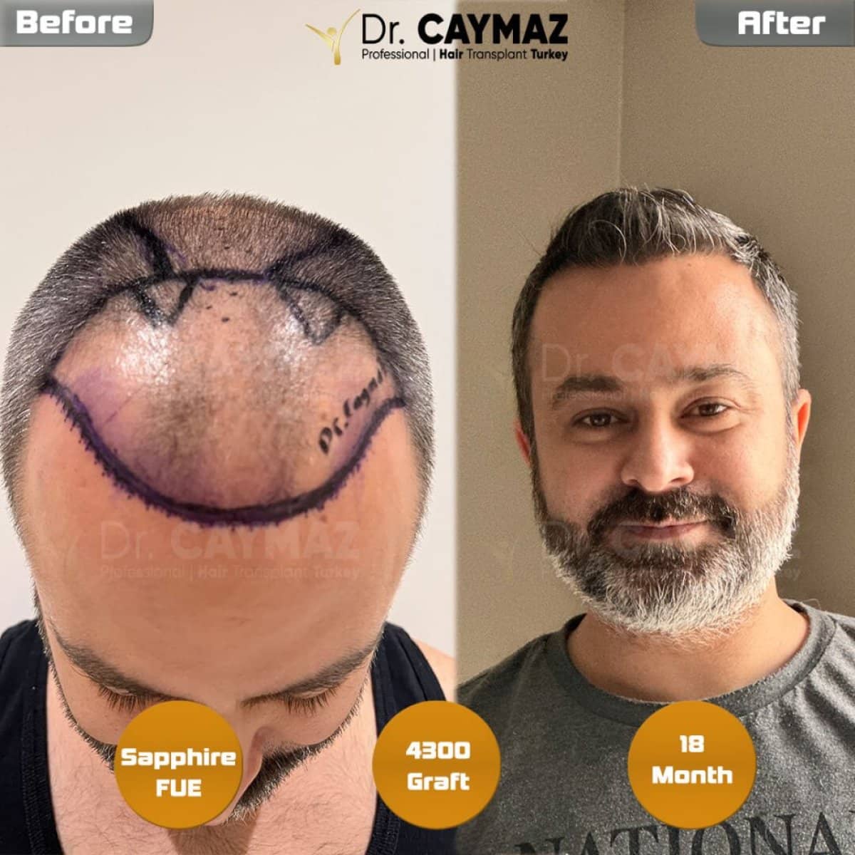 Case 15797 - Sapphire FUE hair transplant