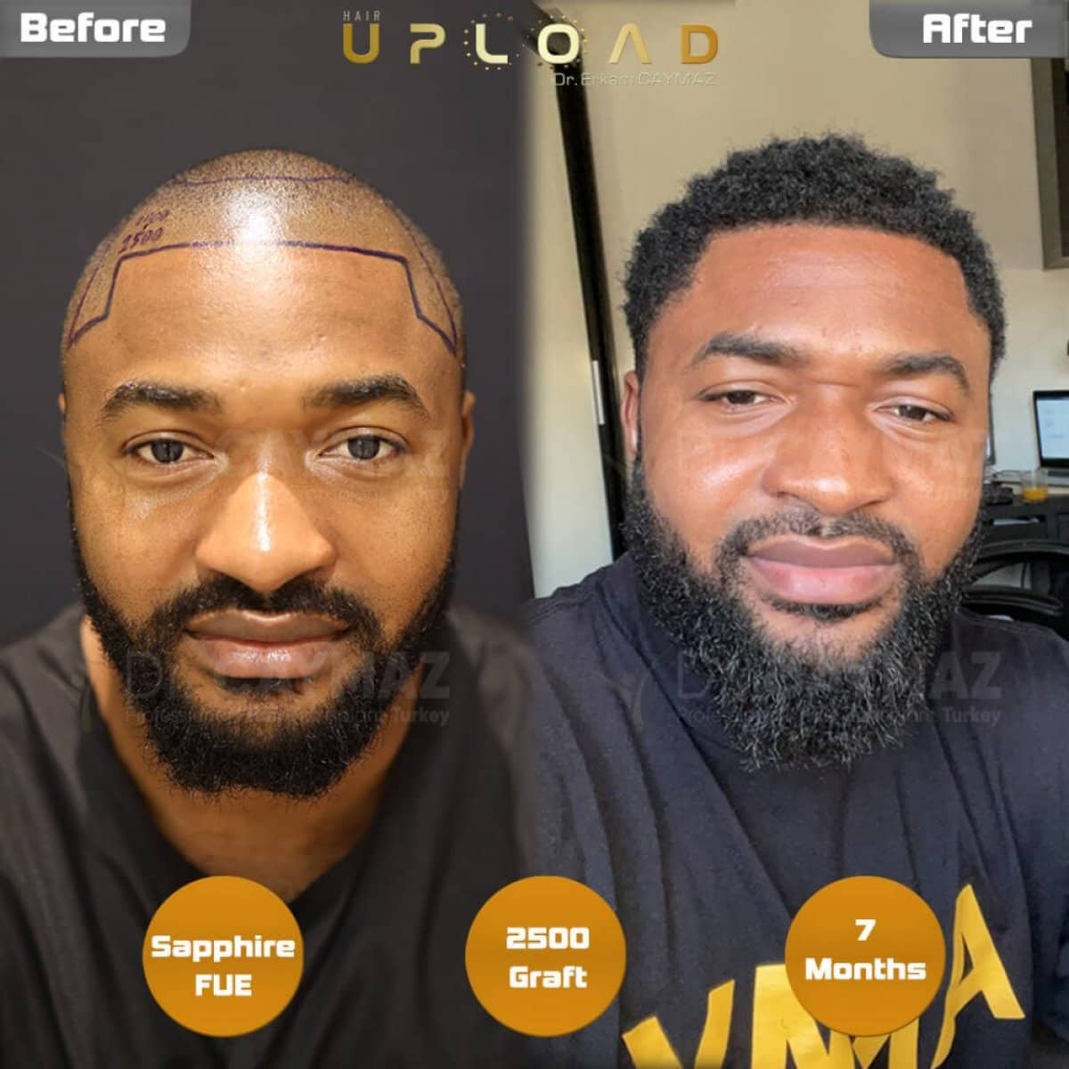 Case 15799 - Sapphire FUE hair transplant