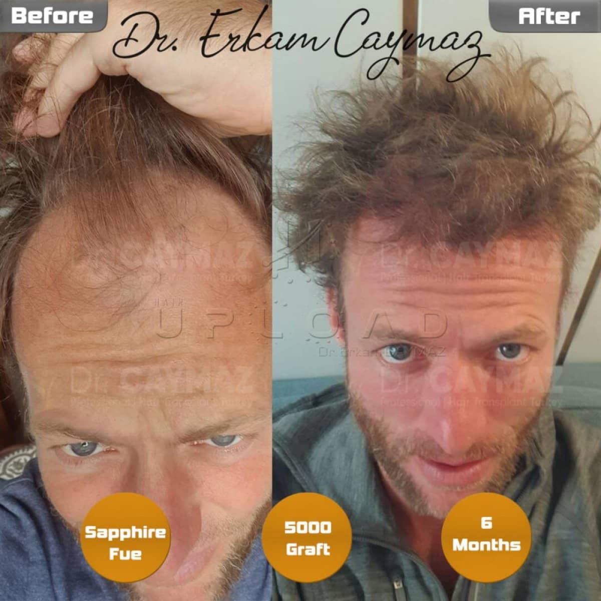 Case 15800 - Sapphire FUE hair transplant