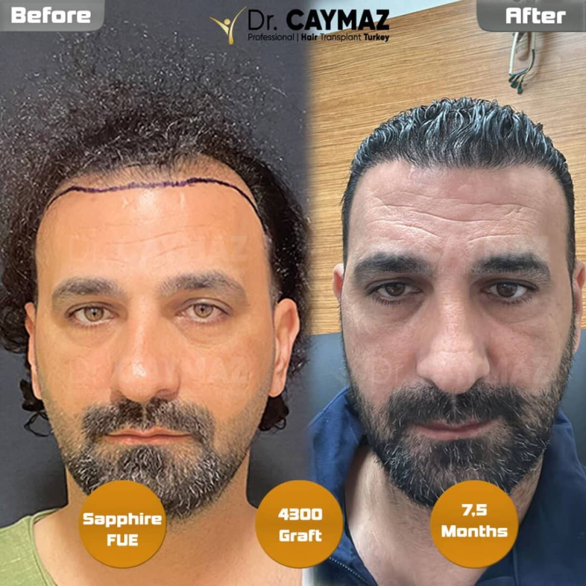 Case 15803 - Sapphire FUE hair transplant, 4300 grafts