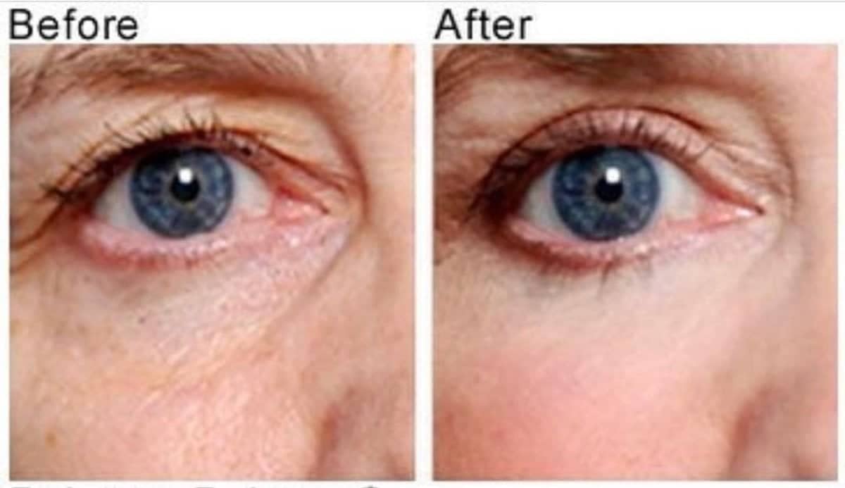 Case 15833 - blepharoplasty