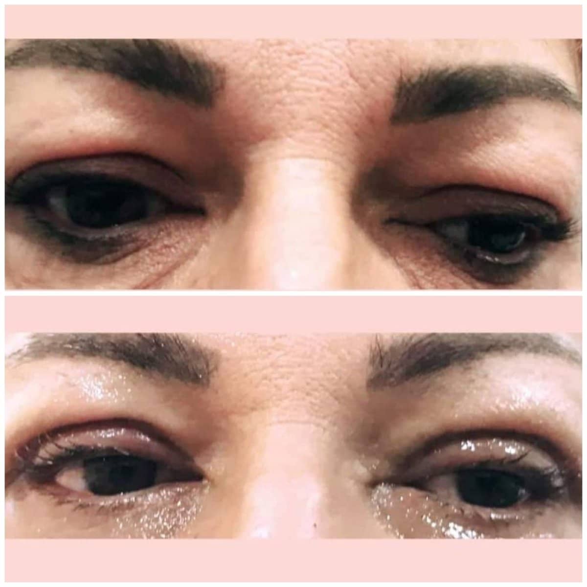 Case 15836 - blepharoplasty