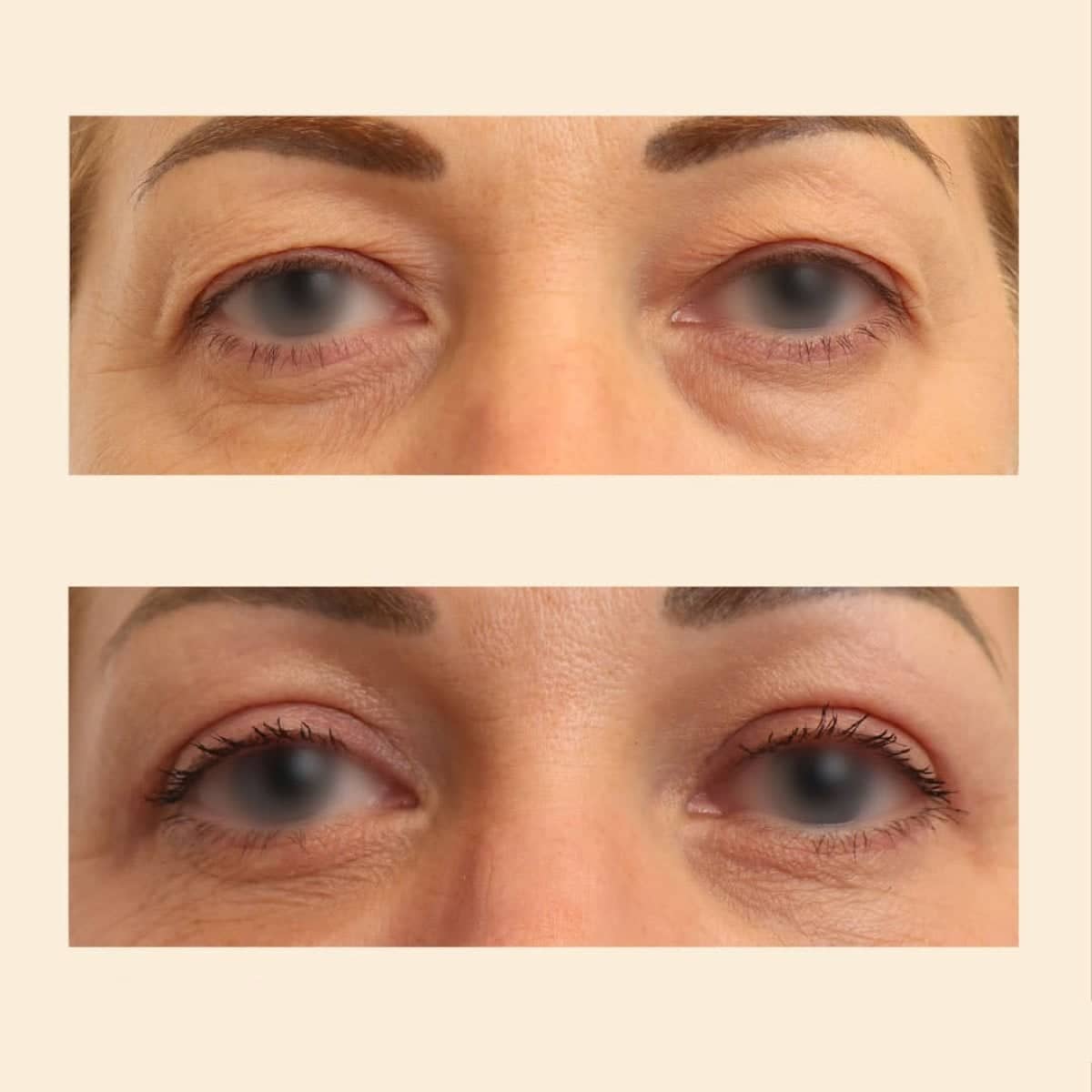 Case 15837 - blepharoplasty
