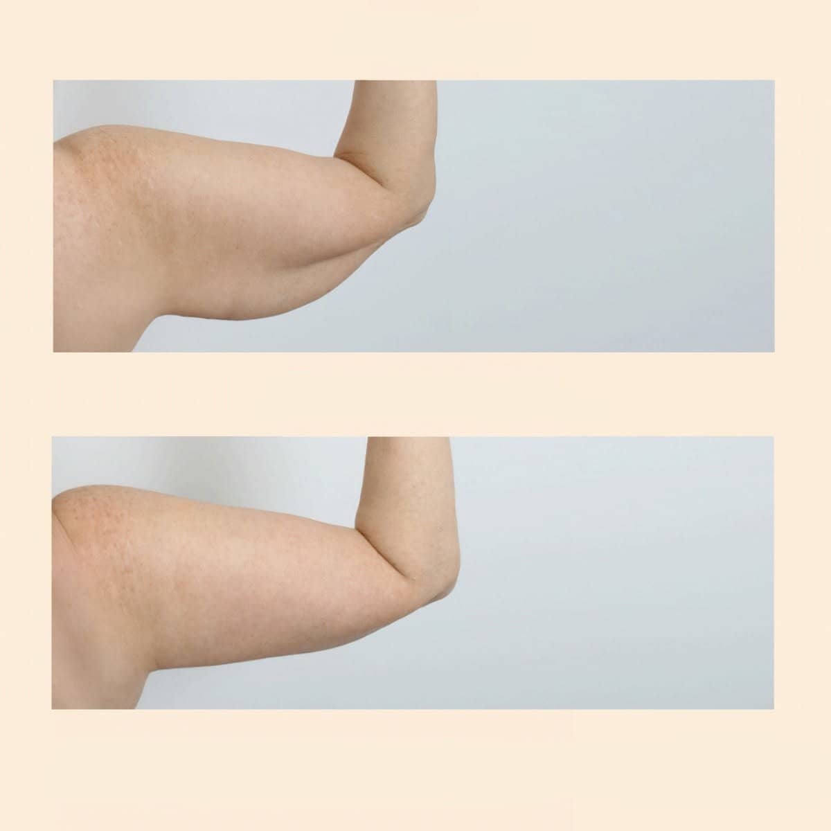 Case 15838 - arm lift (brachioplasty)