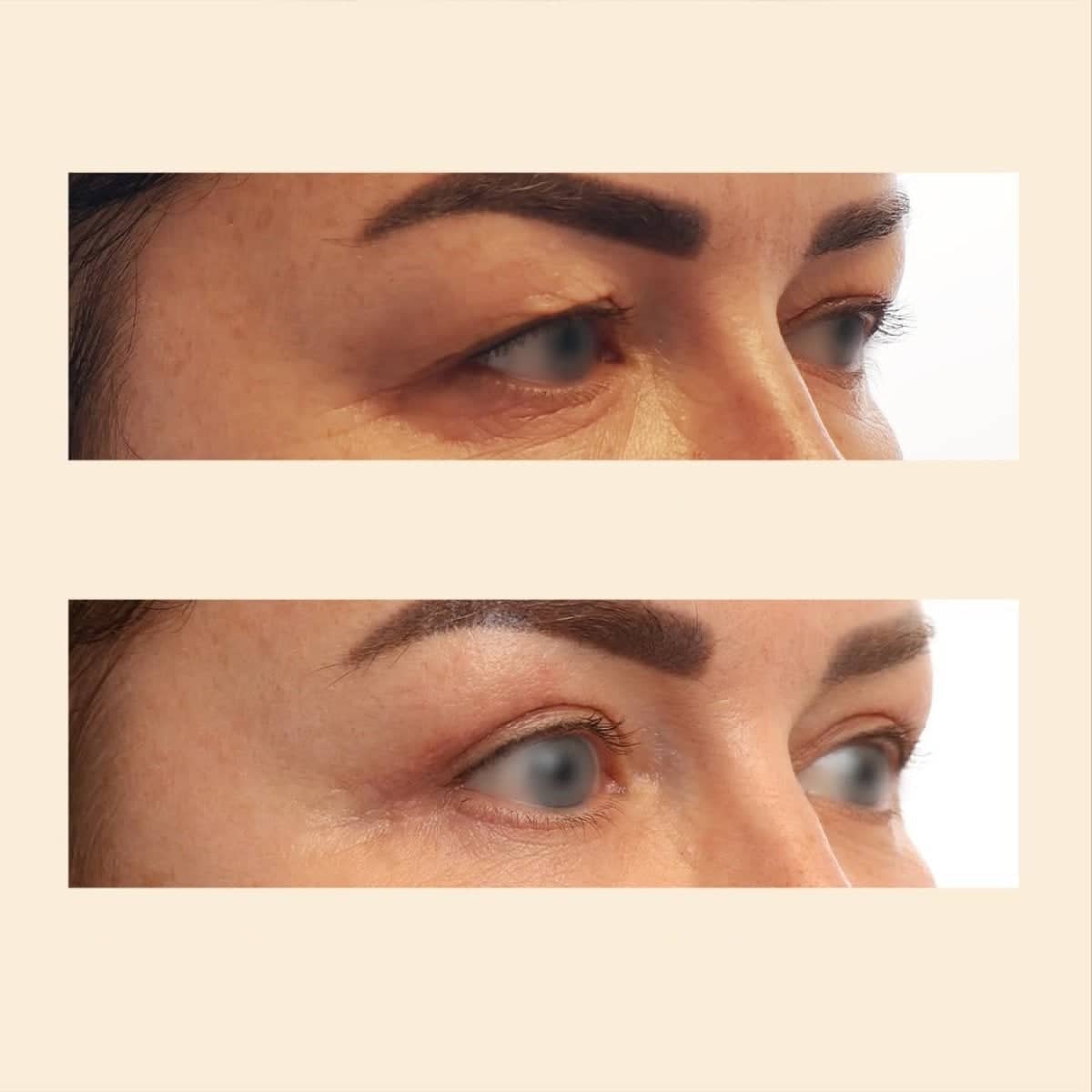 Case 15839 - blepharoplasty