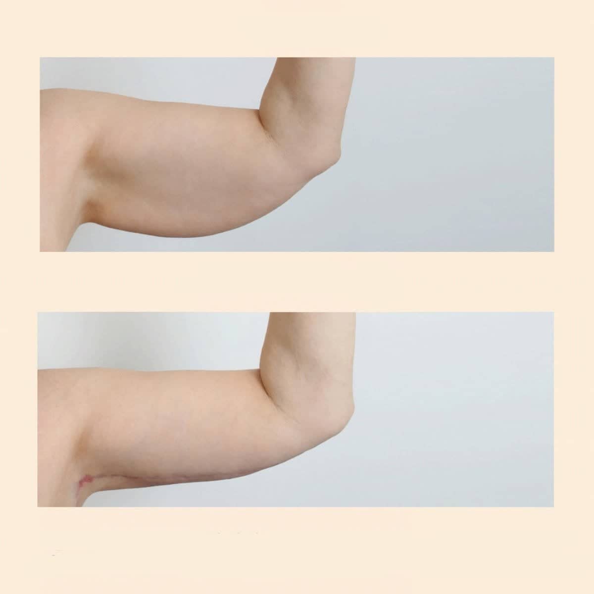 Case 15841 - arm lift (brachioplasty)