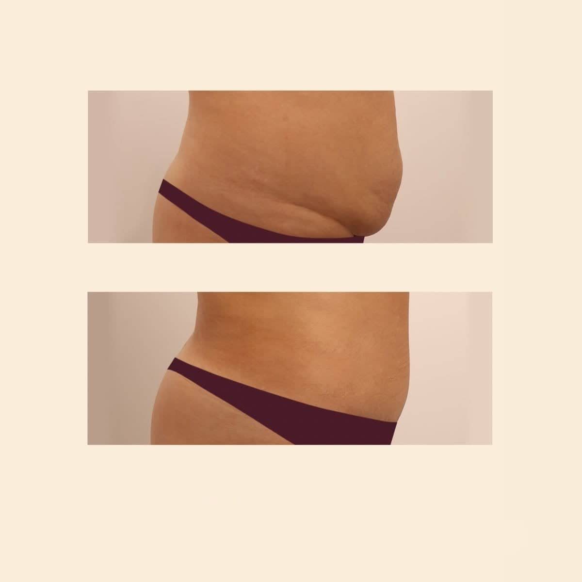 Case 15842 - tummy tuck and liposuction