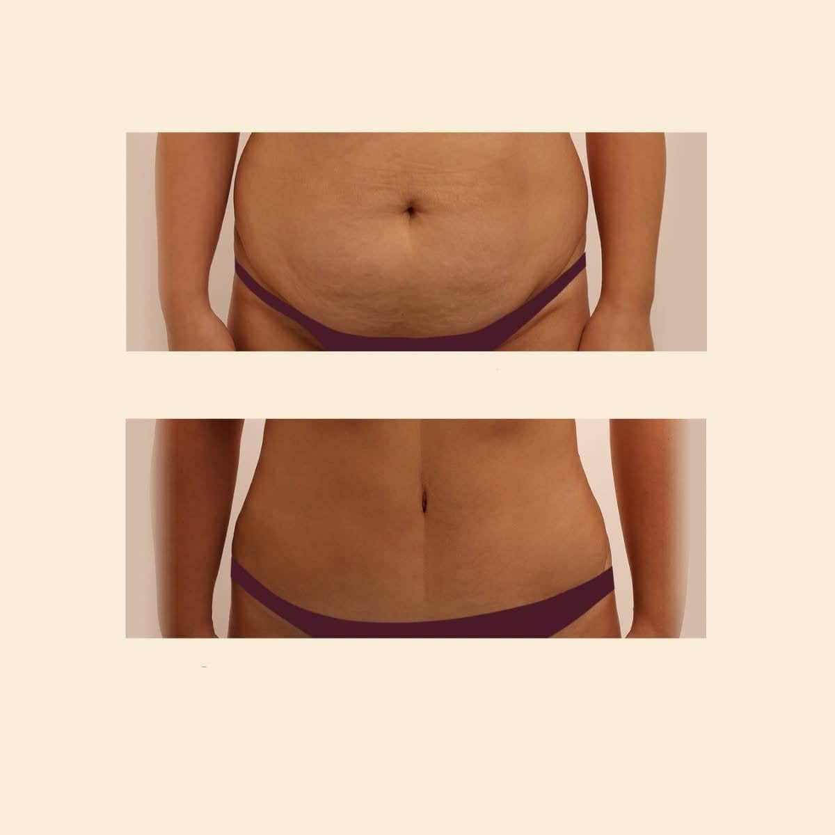 Case 15844 - tummy tuck and liposuction