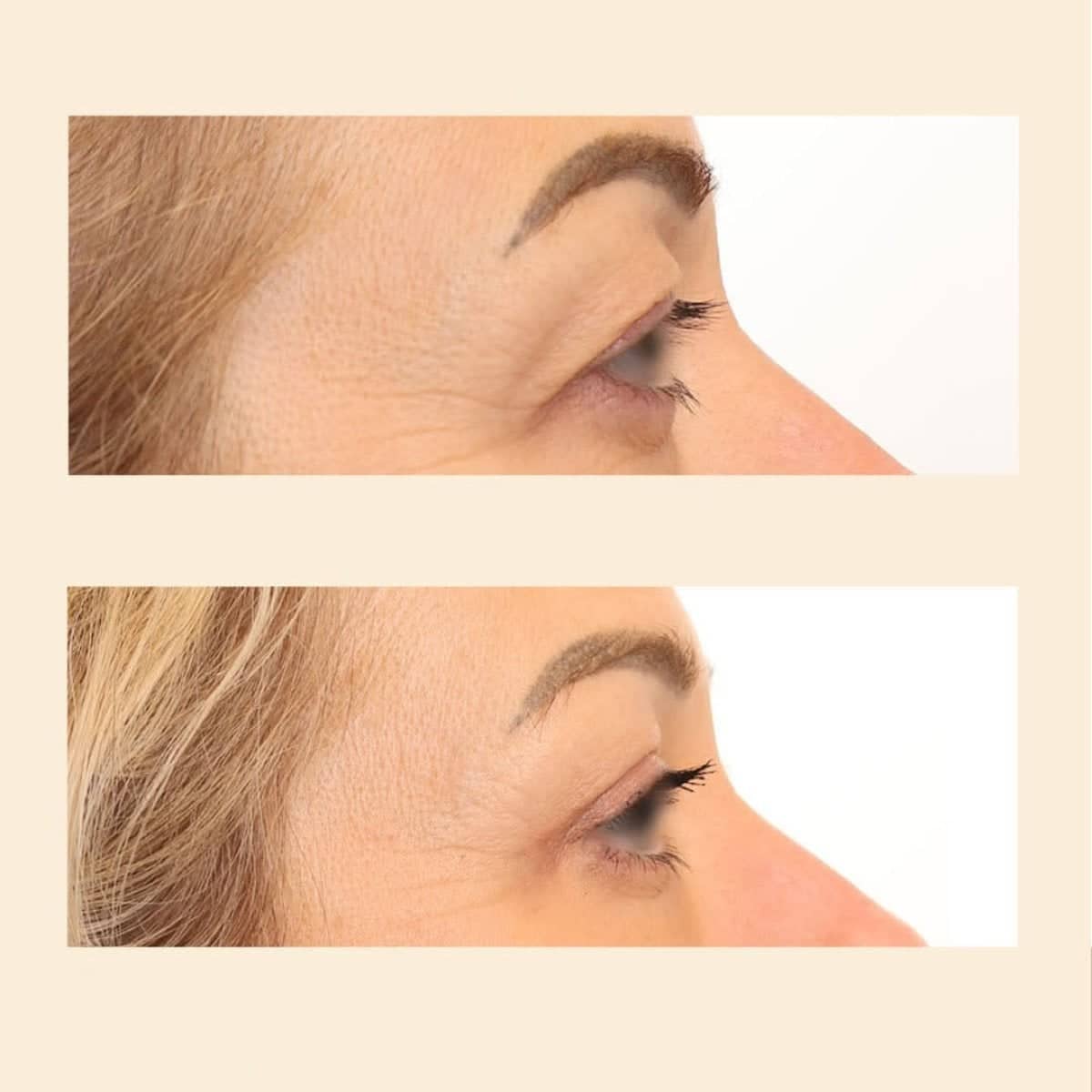 Case 15845 - blepharoplasty