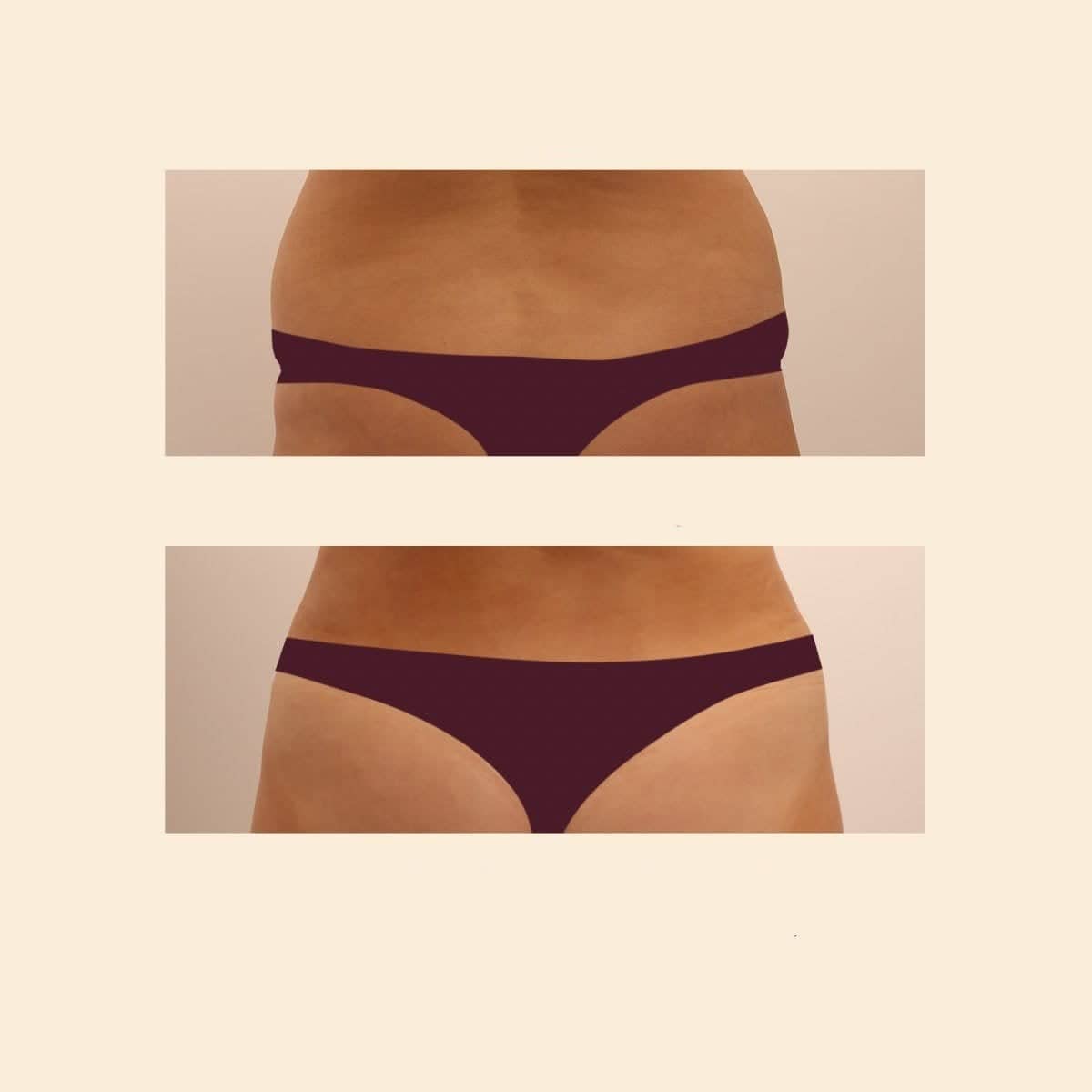 Case 15846 - liposuction
