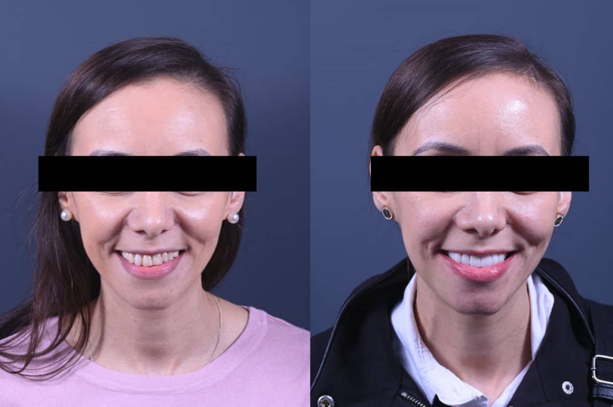 Case 15882 - porcelain veneer