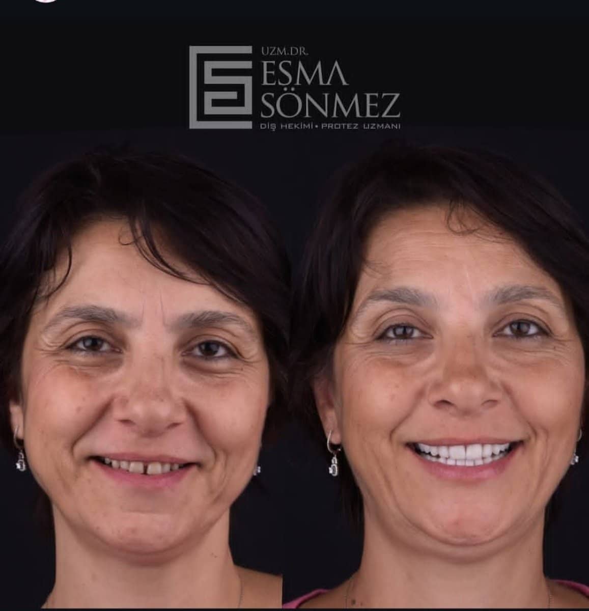 Case 15895 - Invisalign