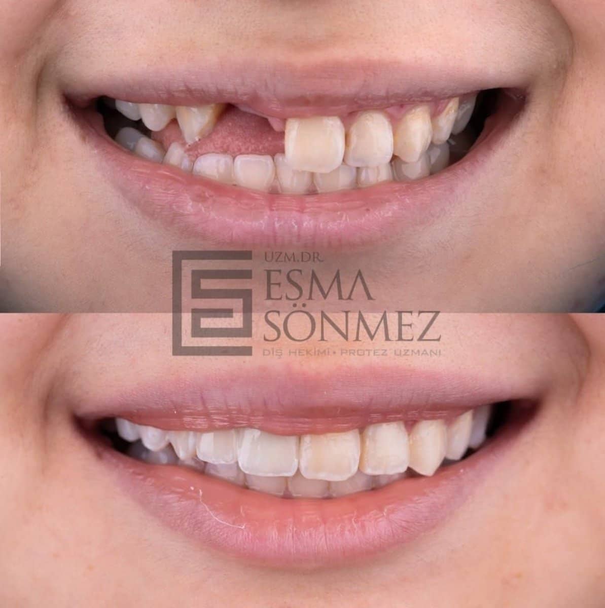 Case 15901 - Invisalign