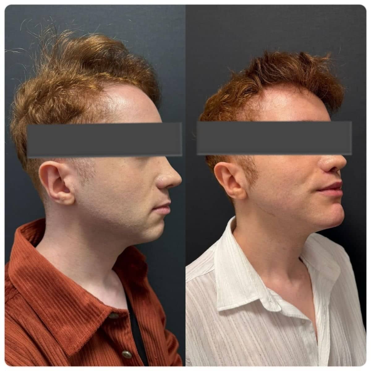 Case 15907 - cheekbone reduction