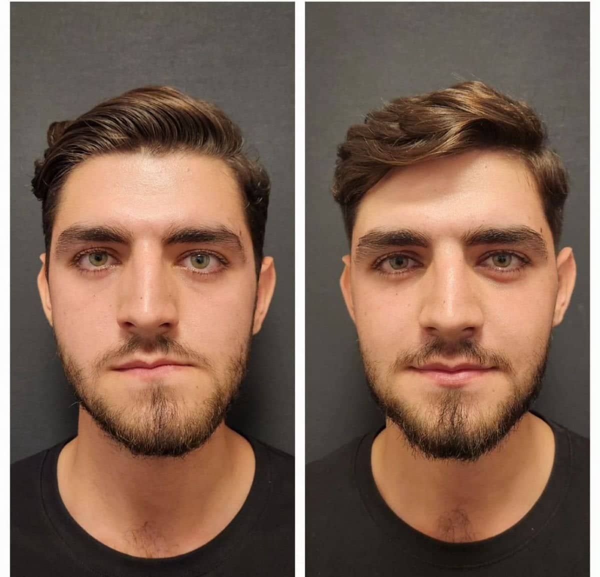 Case 15911 - cheekbone reduction