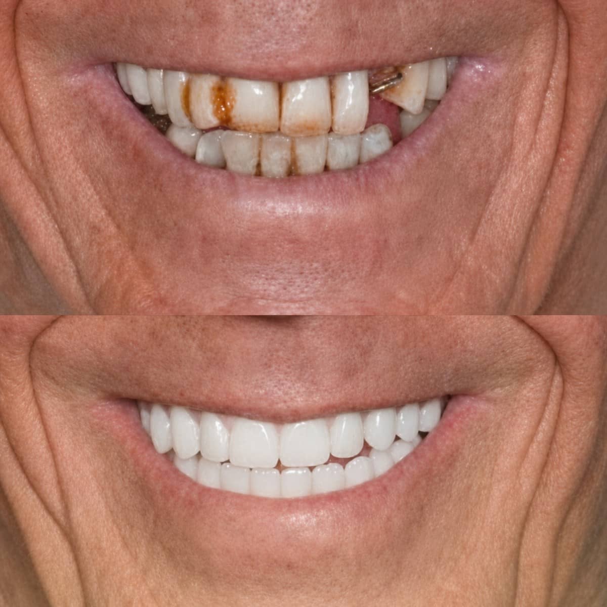 Case 15912 - zygomatic implant