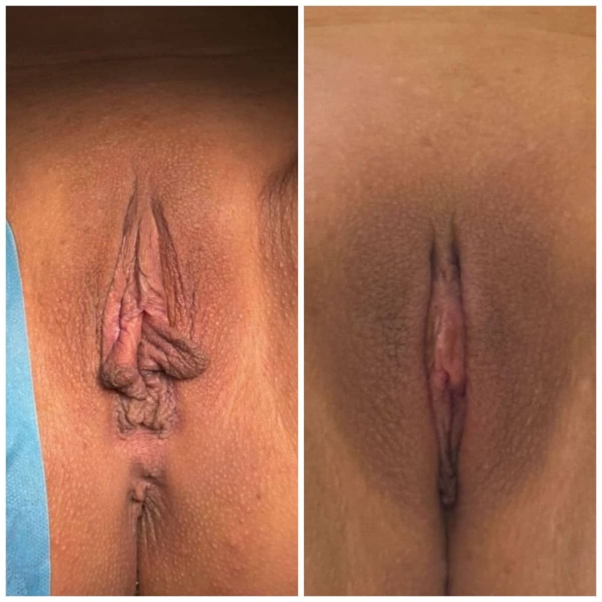 Case 15922 - labiaplasty