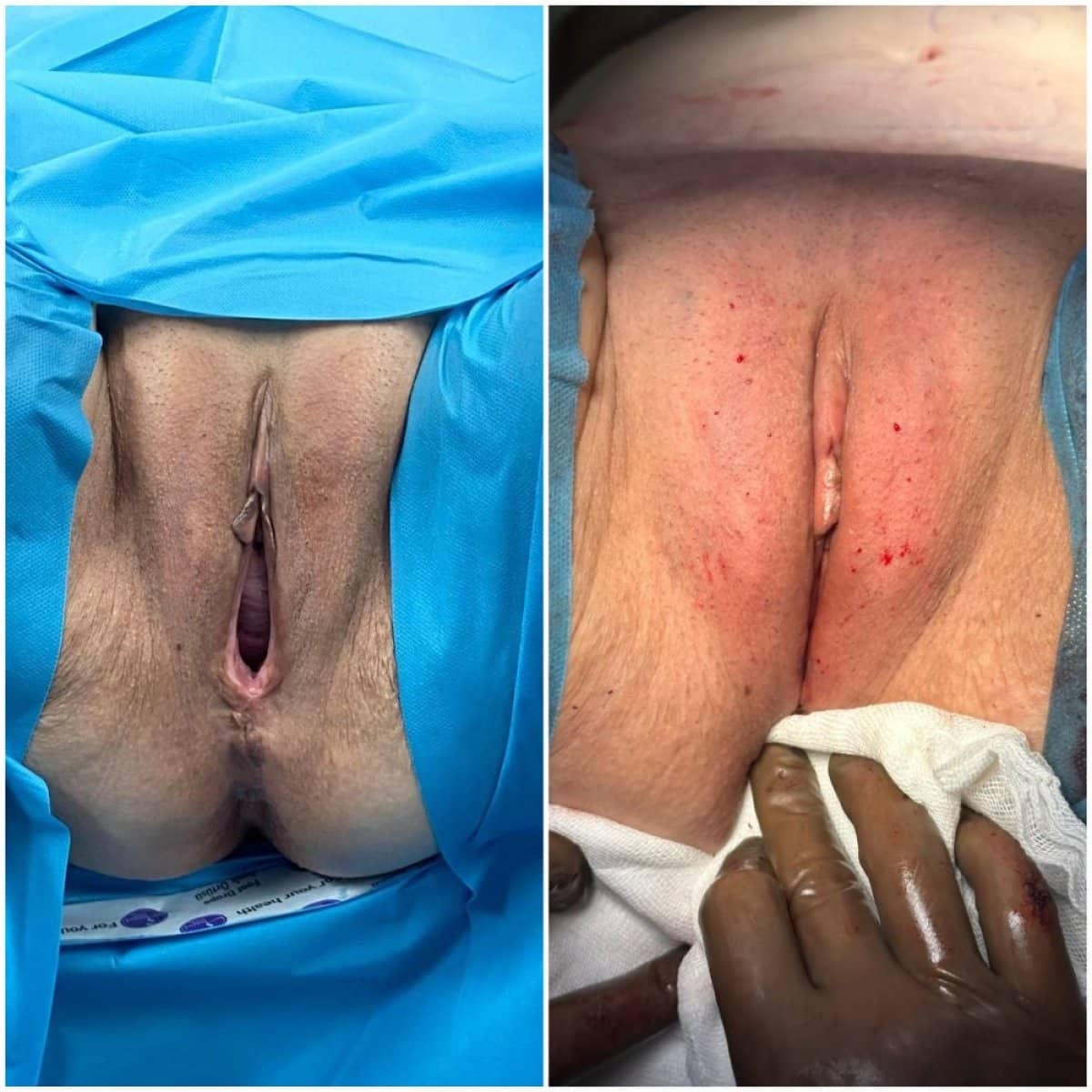Case 15928 - vaginoplasty