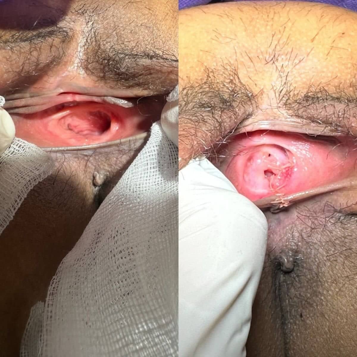 Case 15932 - vaginal laser tightening