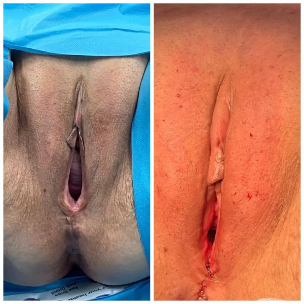 Case 15934 - vaginoplasty