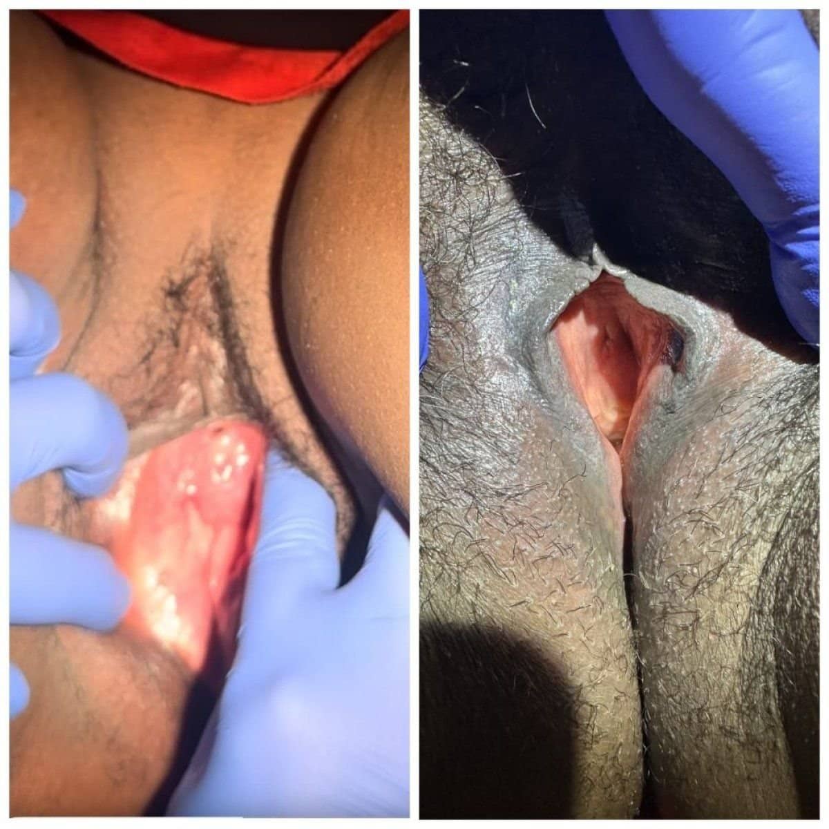 Case 15939 - laser vaginal rejuvenation
