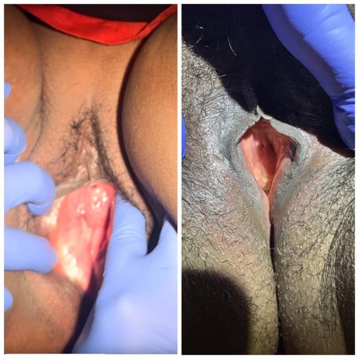 Case 15940 - vaginoplasty