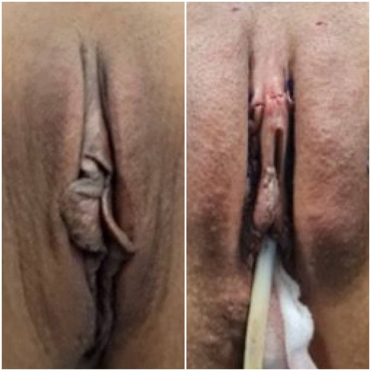 Case 15942 - labiaplasty