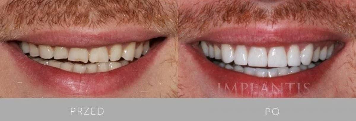 Case 15976 - veneers
