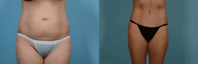 Case 160 - Woman treated with Tummy Tuck