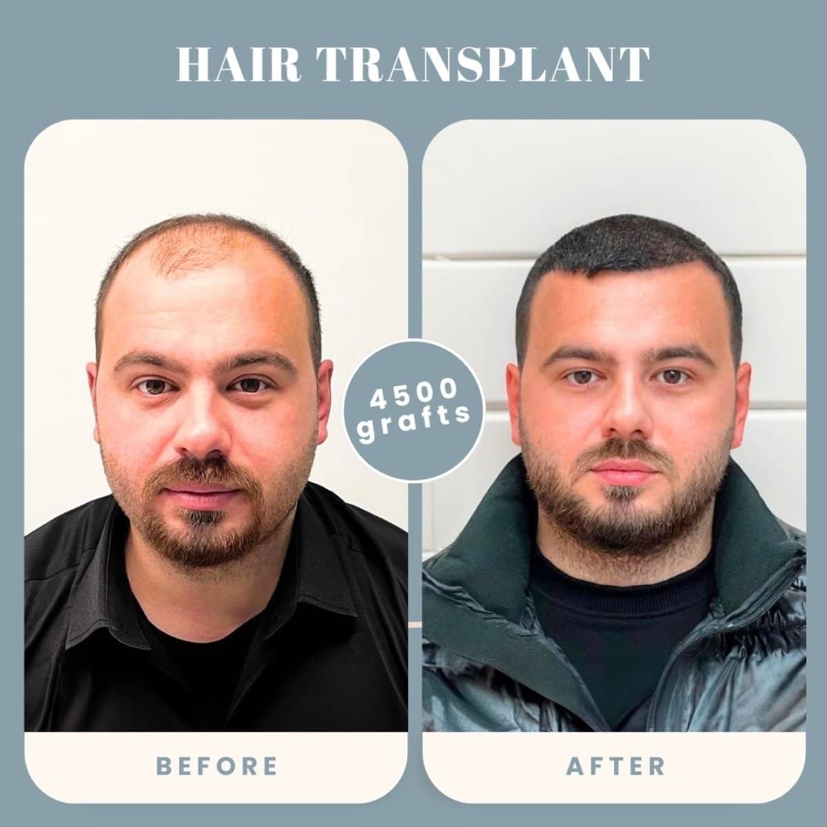 Case 16019 - hair transplant
