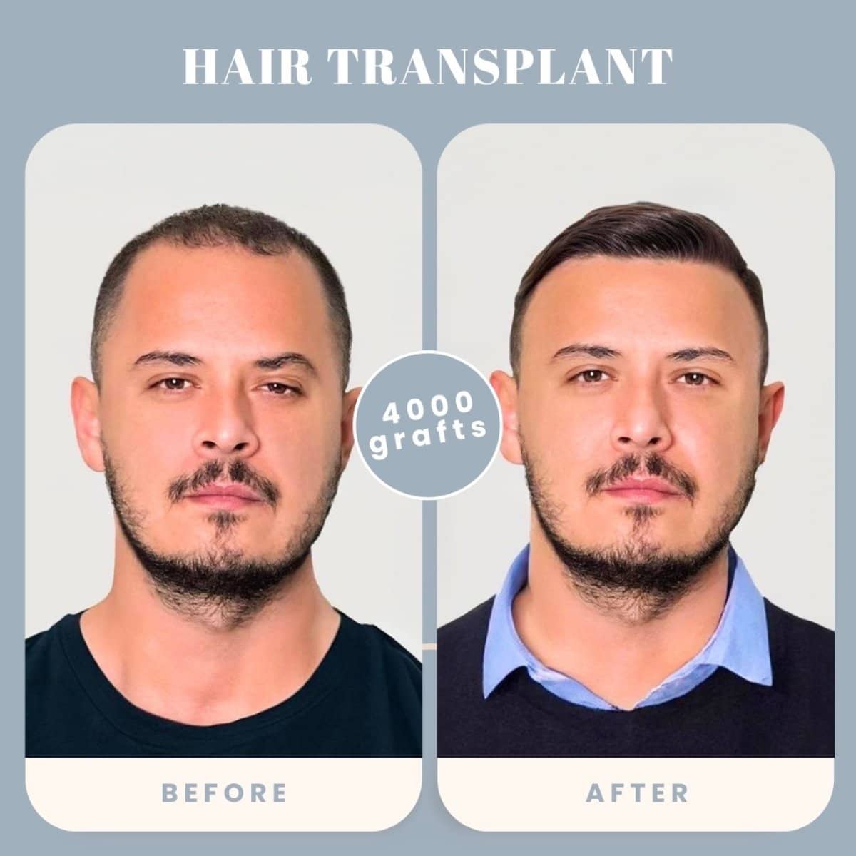 Case 16020 - hair transplant