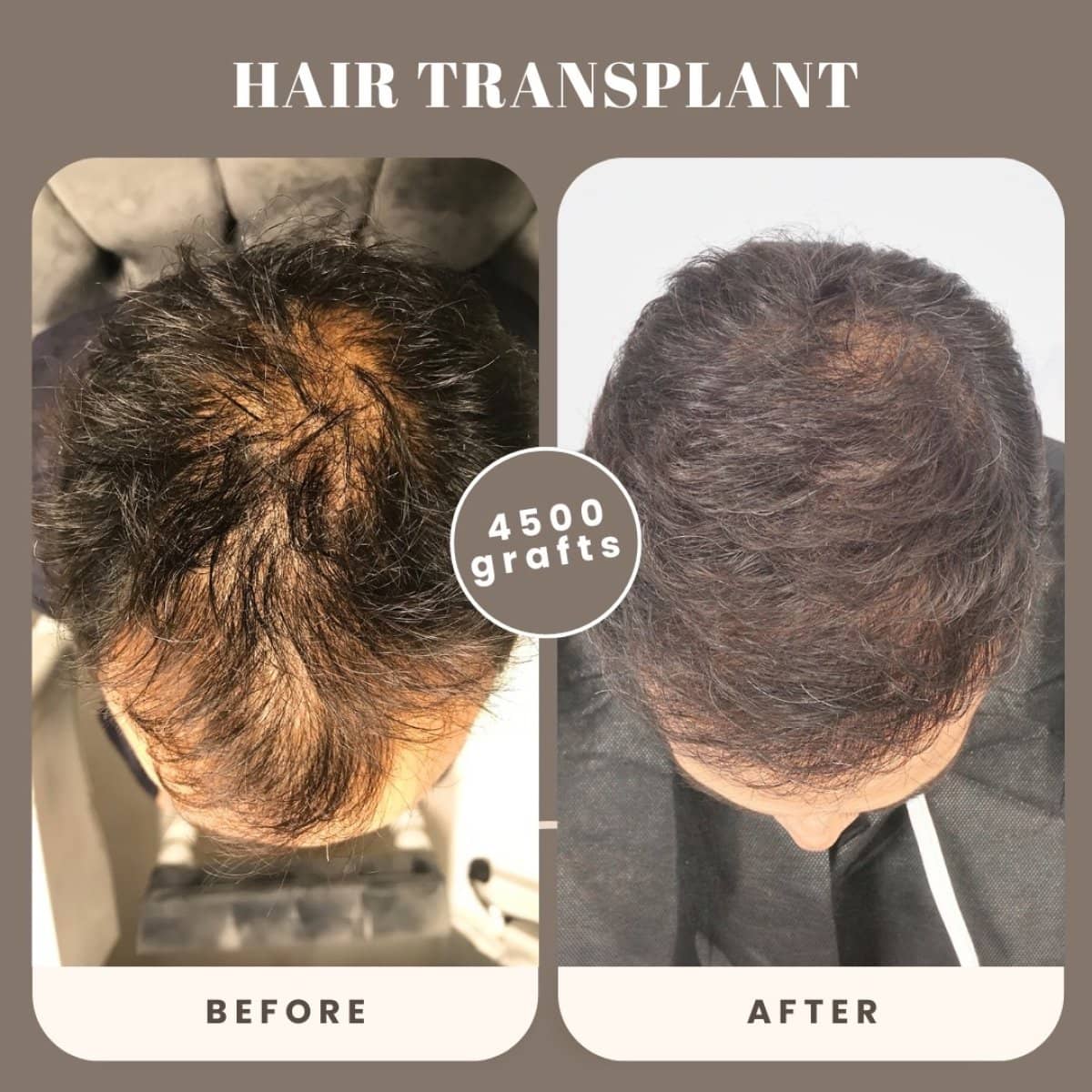 Case 16021 - hair transplant