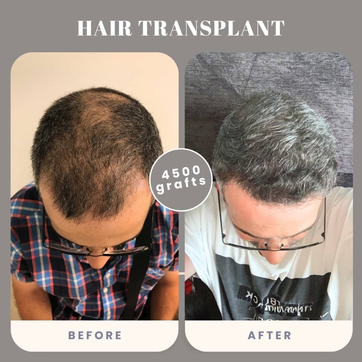 Case 16022 - hair transplant