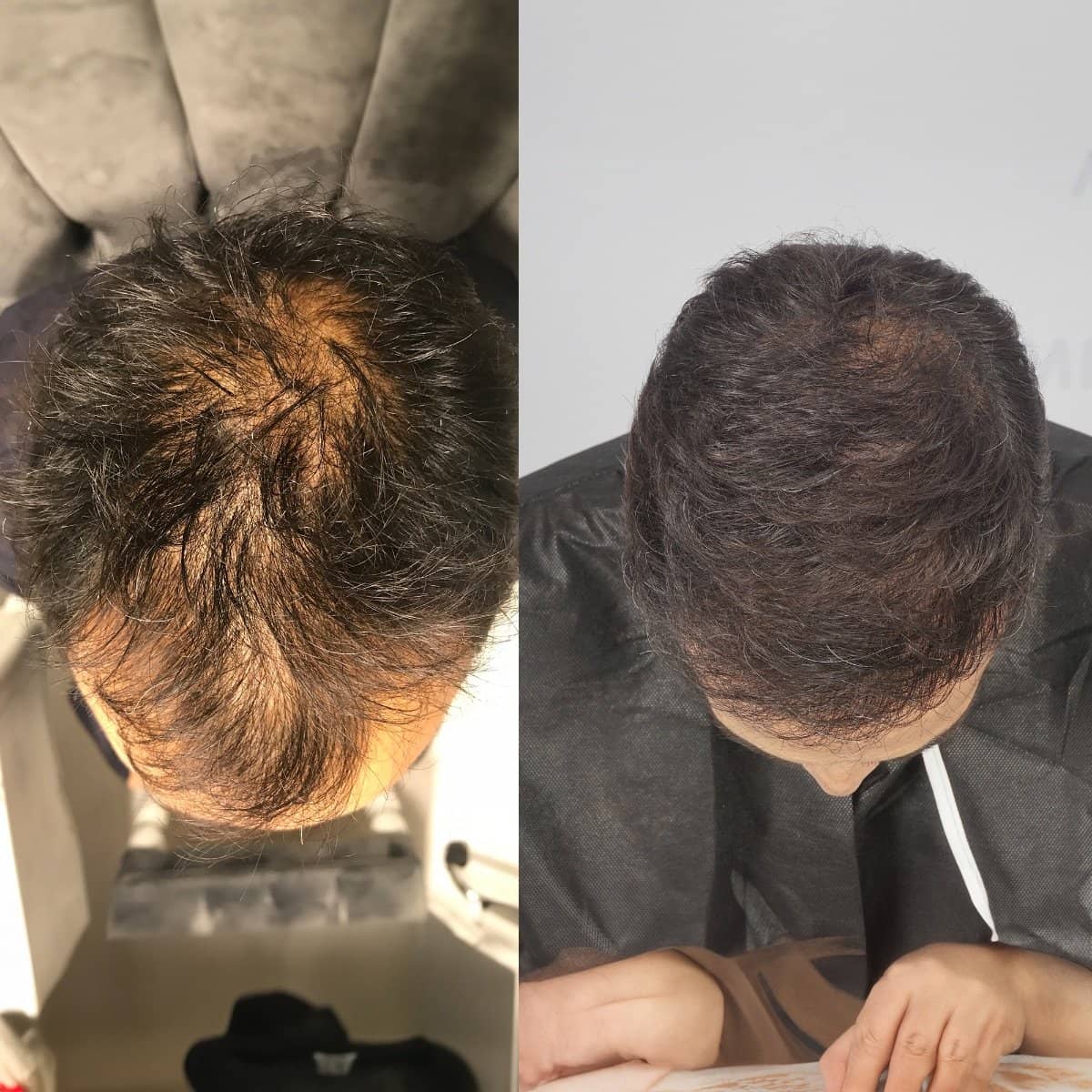Case 16023 - hair transplant