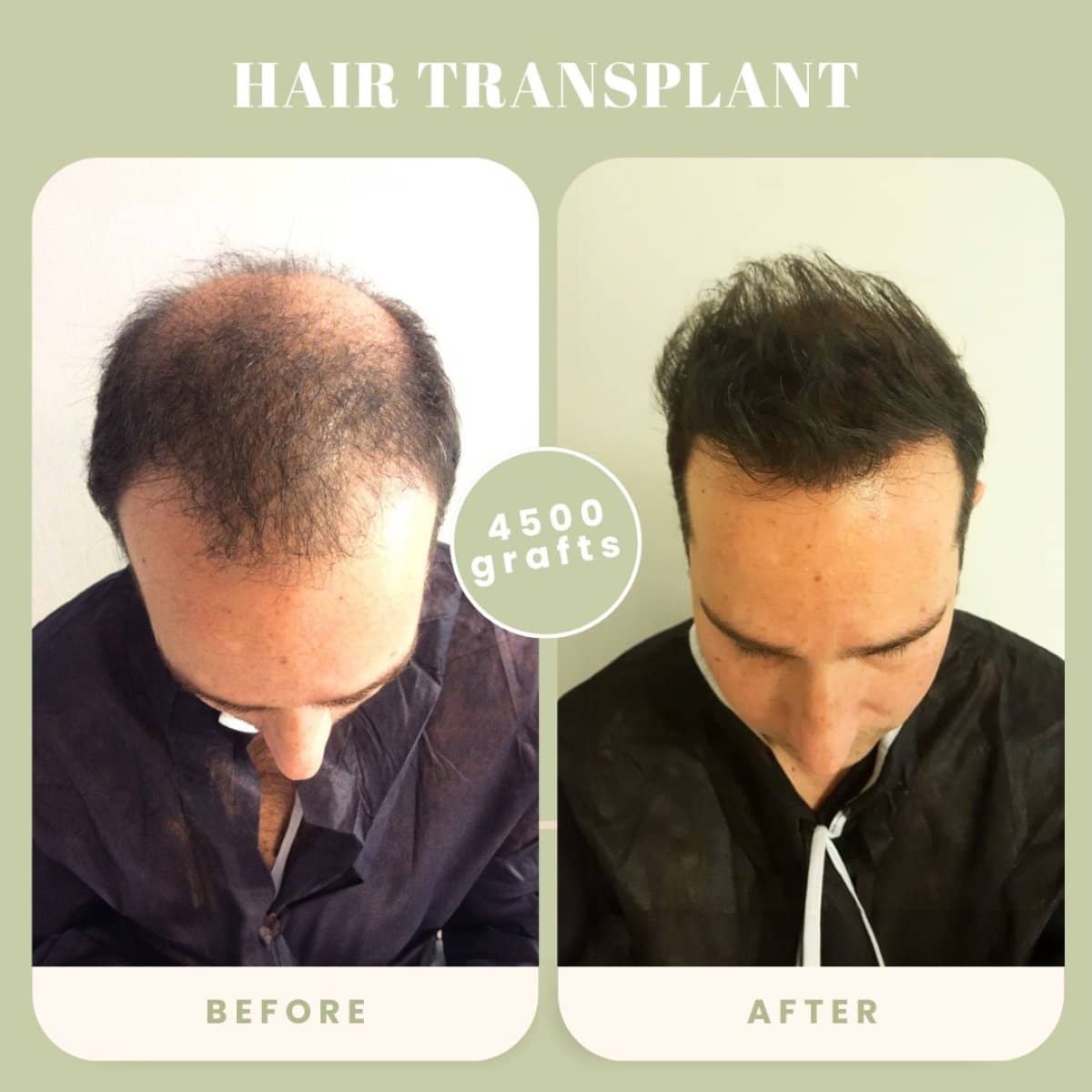 Case 16024 - hair transplant